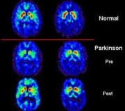 parkinson