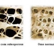 osteoporose
